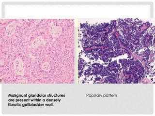 Malignant glandular structures   Papillary pattern
are present within a densely
fibrotic gallbladder wall.
 