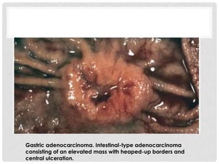 Gastric adenocarcinoma. Intestinal-type adenocarcinoma
consisting of an elevated mass with heaped-up borders and
central ulceration.
 
