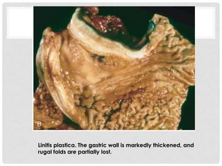 Linitis plastica. The gastric wall is markedly thickened, and
rugal folds are partially lost.
 