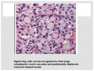 Signet-ring cells can be recognized by their large
cytoplasmic mucin vacuoles and peripherally displaced,
crescent-shaped nuclei.
 