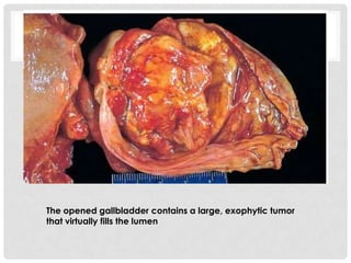 The opened gallbladder contains a large, exophytic tumor
that virtually fills the lumen
 