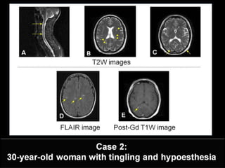 Clinically Isolated Syndrome & Clinically Definite Multiple Sclerosis