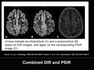 Clinically Isolated Syndrome & Clinically Definite Multiple Sclerosis