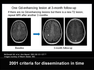 Clinically Isolated Syndrome & Clinically Definite Multiple Sclerosis