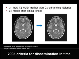 Clinically Isolated Syndrome & Clinically Definite Multiple Sclerosis