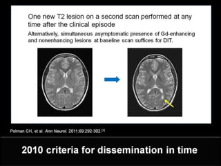 Clinically Isolated Syndrome & Clinically Definite Multiple Sclerosis