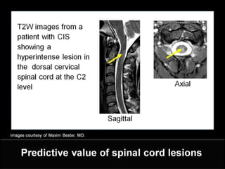 Clinically Isolated Syndrome & Clinically Definite Multiple Sclerosis