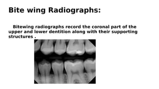 Wing Radiographs 812919183-Diagnostic-aids-in-orthodontics-ppt.pdf
