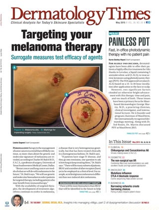 Clinical Analysis for Today’s Skincare Specialists May 2015 | VOL. 36, NO. 05 |
Louise Gagnon | Staff Correspondent
Targeting your
melanoma therapy
Figure A. Melanoma site. B. Markings for
impending surgery Photos: Charles M. Balch, M.D.
Fast, in-offce photodynamic
therapy with no patient pain
Karen Donley-Hayes | Staff Correspondent
InThis Issue May 2015 VOL. 36, NO. 05
CLINICAL 16
Chikungunya and Coxsackievirus A6
Viruses making waves in the U.S.
COSMETIC 22
The non-surgical eye lift
Combining fllers and neuromodulators can yield
excellent results and high patient satisfaction
ONCOLOGY 30
Mutations infuence
CTLA-4 blockade response
Exome sequencing helps predict survival
BUSINESS 46
Narrowing networks create
harrowing choices
Paring of plans impacts patient choice
| THE TAKEAWAY | SEEMAL DESAI, M.D., Insights into managing vitiligo, part 2 of dyspigmentation discussion SEE PAGE 52
Personalizedtherapyinthemanagement
ofsomecancersisatrendthatwilllikelycon-
tinue, as more clues about the genetic and
molecular signature of melanoma are re-
vealed,accordingtoCharlesM.BalchM.D.,
F.A.C.S.,aprofessorofsurgery,Universityof
TexasSouthwesternMedicalCenter,Dallas.
ÒBreastcancerandlungcanceraremod-
elsofwhatwewilldowithmelanomainthe
future,ÓDr.Balchsays.ÒWewillusegenetic
andmolecularbiomarkerstoselectpatients
fortargetedtherapy,includingpatientswho
may benefit from immunotherapy.Ó
With the availability of targeted thera-
pies, the development of treatment algo-
rithms continues to evolve in melanoma,
Surrogate measures test efficacy of agents
a disease that is very heterogeneous genet-
ically, but that has been treated clinically
in a homogeneous fashion, Dr. Balch says.
ÒIf patients have stage IV disease, and
they go into remission, one question to ask
ishowlongtokeeptreatingthem,ÓDr.Balch
says.ÒTherewillbemanysubsetsofpatients.
BRAFandanumberofotherreceptors[have]
yettobeemployedataclinicallevel.Forex-
ample,acrallentiginousmelanomaisdiffer-
entthansun-inducedskinmelanoma.
BIOMARKERSANDNEO-ADJUVANTTHERAPY
ÒTherewillbemorebiomarkersthanBRAF
that will be identified in the future to help
A
B
TARGETING see page 45
For nearly two decades, dermatol-
ogists have been able to offer their pa-
tientsahighlyeffectivetreatmentforAKs
thanks to Levulan, a liquid containing 5
aminolevulinic acid (5-ALA), to treat ac-
tinickeratosesusingphotodynamicther-
apy(PDT).TheFDAapprovedLevulan(5-
ALA) based on a 14- to 18-hour incuba-
tion after application to the face or scalp.
However, two significant factors
clouded an otherwise bright advance-
ment with this therapy: time and pain,
and too much of both. These issues
havebeenaprimaryfocusforMaui-
based dermatologist George Mar-
tin, M.D., a practicing clinician,
clinical investigator, and interna-
tional lecturer. He is founder and
program chairman of MauiDerm,
theinternationallyrecognizedder-
matology meeting. Along with Dr.
Ted Rosen, Dr. Martin discussed
PDT at MauiDerm 2015.
PAINLESS PDT
ONCOLOGY
PAINLESS PDT see page 42
DermatologyTimes®
May2015Volume36No.05ClinicalAnalysisforToday’sSkincareSpecialistsDermatologyTimes.com
ES603013_DT0515_CV1.pgs 04.22.2015 20:35 ADVblackyellowmagentacyan
 