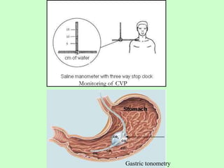 Monitoring of CVP
Gastric tonometry
 