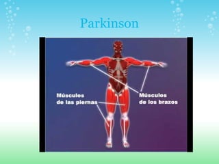 Parkinson 