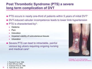 DVT Presentation1 preview | PPTX