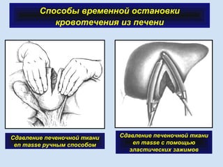 Способы временной остановки
кровотечения из печени
 
Сдавление печеночной ткани
en masse ручным способом
Сдавление печеночной ткани
en masse с помощью
эластических зажимов
 