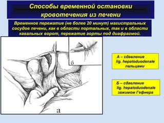 Способы временной остановки
кровотечения из печени
 
Временное пережатие (не более 20 минут) магистральных
сосудов печени, как в области портальных, так и в области
кавальных ворот, пережатие аорты под диафрагмой.
А – сдавление
lig. hepatoduodenale
пальцами
Б – сдавление
lig. hepatoduodenale
зажимом Гефнера
 