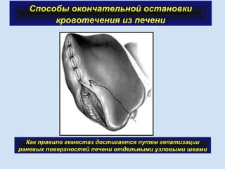 Способы окончательной остановки
кровотечения из печени
 
Как правило гемостаз достигается путем гепатизации
раневых поверхностей печени отдельными узловыми швами
 