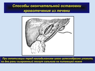 Способы окончательной остановки
кровотечения из печени
 
При гепатизации перед накладыванием швов целесообразно уложить
на дно раны выкроенный лоскут сальника на питающей ножке
 