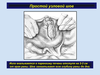 Простой узловой шов
Игла вкалывается в паренхиму печени отступя на 2-3 см
от края раны. Шов захватывает всю глубину раны до дна.
 