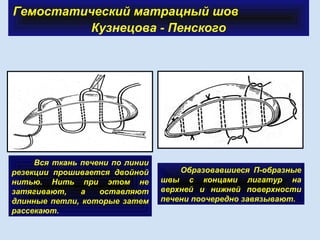 Гемостатический матрацный шов
Кузнецова - Пенского
Образовавшиеся П-образные
швы с концами лигатур на
верхней и нижней поверхности
печени поочередно завязывают.
Вся ткань печени по линии
резекции прошивается двойной
нитью. Нить при этом не
затягивают, а оставляют
длинные петли, которые затем
рассекают.
 