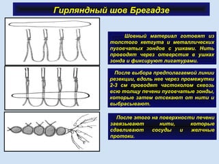 Гирляндный шов Брегадзе
Шовный материал готовят из
толстого кетгута и металлических
пуговчатых зондов с ушками. Нить
проводят через отверстия в ушках
зонда и фиксируют лигатурами.
После выбора предполагаемой линии
резекции, вдоль нее через промежутки
2-3 см проводят частоколом сквозь
всю толщу печени пуговчатые зонды,
которые затем отсекают от нити и
выбрасывают.
После этого на поверхности печени
завязывают нити, которые
сдавливают сосуды и желчные
протоки.
 