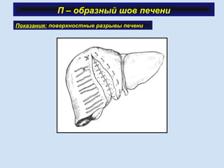 П – образный шов печени
Показания: поверхностные разрывы печени
 