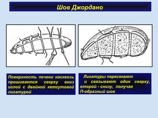Шов Джордано
Поверхность печени насквозь
прошивается сверху вниз
иглой с двойной кетгутовой
лигатурой
Лигатуры пересекают
и связывают один сверху,
второй - снизу, получая
П-образный шов
 