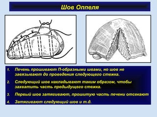 Шов Оппеля
1. Печень прошивают П-образными швами, но шов не
завязывают до проведения следующего стежка.
2. Следующий шов накладывают таким образом, чтобы
захватить часть предыдущего стежка.
3. Первый шов затягивают, прошитую часть печени отсекают
4. Затягивают следующий шов и т.д.
 