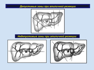 Допустимые зоны при атипичной резекции
Недопустимые зоны при атипичной резекции
 
