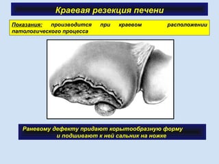 Краевая резекция печени
Раневому дефекту придают корытообразную форму
и подшивают к ней сальник на ножке
Показания: производится при краевом расположении
патологического процесса
 
