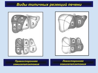 Виды типичных резекций печени
Правосторонняя
гемигепатэктомия
Левосторонняя
гемигепатэктомия
 