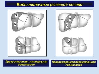 Виды типичных резекций печени
Правосторонняя латеральная
лобэктомия
Правосторонняя парамедианная
лобэктомия
 