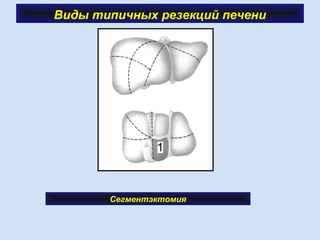 Виды типичных резекций печени
Сегментэктомия
 