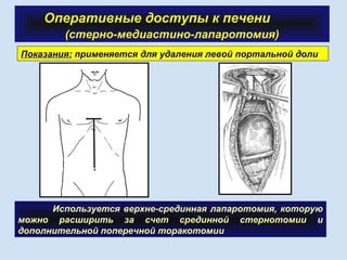 Оперативные доступы к печени
(стерно-медиастино-лапаротомия)
Используется верхне-срединная лапаротомия, которую
можно расширить за счет срединной стернотомии и
дополнительной поперечной торакотомии
Показания: применяется для удаления левой портальной доли.
 