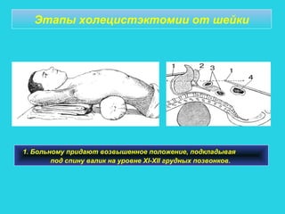 Этапы холецистэктомии от шейки
1. Больному придают возвышенное положение, подкладывая
под спину валик на уровне XI-XII грудных позвонков.
 