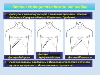 Этапы холецистэктомии от шейки
2. Доступы к желчному пузырю и желчным протокам: доступ
Федорова, Курвуазье-Кохера, Шпренгеля, Прибрама.
Доступ Федорова
Доступ
Курвуазье-Кохера Доступ Шпренгеля
3. Ревизия пальцем введенным в Винслово отверстие желчного
пузыря, пузырного и общего желчного протоков.
 