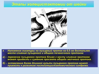 Этапы холецистэктомии от шейки
4. Наложение лигатуры на пузырный проток на 0,5 см дистальнее
места слияния пузырного и общего печеночного протоков
а) - перевязка пузырного протока ближе к месту слияния протоков
может привести к сужению просвета общего желчного протока.
б) - оставление более длинной культи пузырного протока может
привести к развитию постхолецистэктомического синдрома.
 