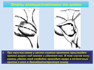 Этапы холецистэктомии от шейки
5. При наличие камня у места слияния протоков производят
прямой разрез над камнем и удаляют его. В том случае если
камень удален зонд свободно проходит вверх в печеночный
проток и вниз в двенадцатиперстную кишку.
 