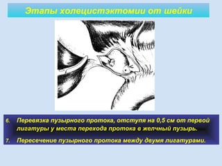 Этапы холецистэктомии от шейки
6. Перевязка пузырного протока, отступя на 0,5 см от первой
лигатуры у места перехода протока в желчный пузырь.
7. Пересечение пузырного протока между двумя лигатурами.
 