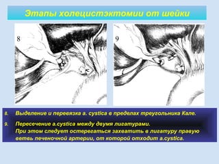 Этапы холецистэктомии от шейки
8. Выделение и перевязка a. cystica в пределах треугольника Кале.
9. Пересечение а.сystica между двумя лигатурами.
При этом следует остерегаться захватить в лигатуру правую
ветвь печеночной артерии, от которой отходит a.cystica.
8 9
 