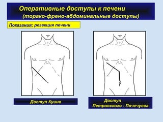 Оперативные доступы к печени
(торако-френо-абдоминальные доступы)
Показания: резекция печени
Доступ Куино Доступ
Петровского - Почечуева
 