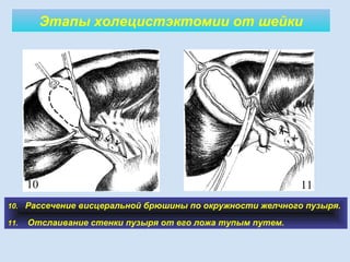 Этапы холецистэктомии от шейки
10. Рассечение висцеральной брюшины по окружности желчного пузыря.
11. Отслаивание стенки пузыря от его ложа тупым путем.
10 11
 