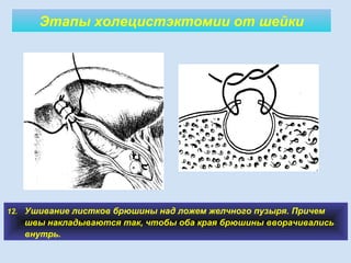 Этапы холецистэктомии от шейки
12. Ушивание листков брюшины над ложем желчного пузыря. Причем
швы накладываются так, чтобы оба края брюшины вворачивались
внутрь.
10
 