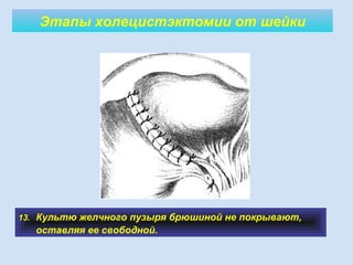 Этапы холецистэктомии от шейки
13. Культю желчного пузыря брюшиной не покрывают,
оставляя ее свободной.
 