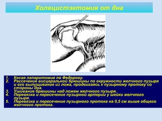 Холецистэктомия от дна
1. Косая лапаротомия по Федорову.
2. Рассечение висцеральной брюшины по окружности желчного пузыря
и его вылущивание из ложа, продвигаясь к пузырному протоку со
стороны дна.
3. Ушивание брюшины над ложем желчного пузыря.
4. Перевязка и пересечение пузырной артерии у шейки желчного
пузыря.
5. Перевязка и пересечение пузырного протока на 0,5 см выше общего
желчного протока.
 