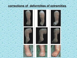 corrections of deformities of extremities.
 