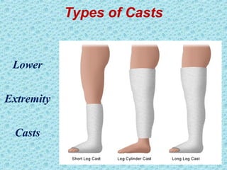Types of Casts
Lower
Extremity
Casts
 