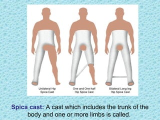 Spica cast: A cast which includes the trunk of the
body and one or more limbs is called.
 