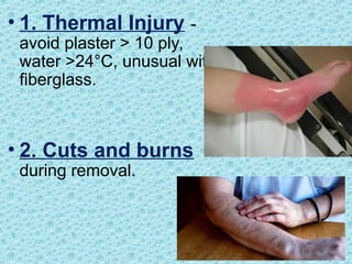 • 1. Thermal Injury -
avoid plaster > 10 ply,
water >24°C, unusual with
fiberglass.
• 2. Cuts and burns
during removal.
 