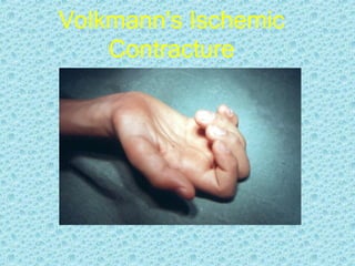Volkmann's Ischemic
Contracture
 