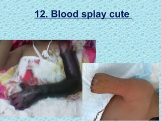 12. Blood splay cute
 