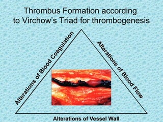 A
l
t
e
r
a
t
i
o
n
s
o
f
B
l
o
o
d
C
o
a
g
u
l
a
t
i
o
n
A
l
t
e
r
a
t
i
o
n
s
o
f
B
l
o
o
d
C
o
a
g
u
l
a
t
i
o
n
A
l
t
e
r
a
t
i
o
n
s
o
f
B
l
o
o
d
F
l
o
w
A
l
t
e
r
a
t
i
o
n
s
o
f
B
l
o
o
d
F
l
o
w
Alterations of Vessel Wall
Alterations of Vessel Wall
Thrombus Formation according
to Virchow’s Triad for thrombogenesis
 